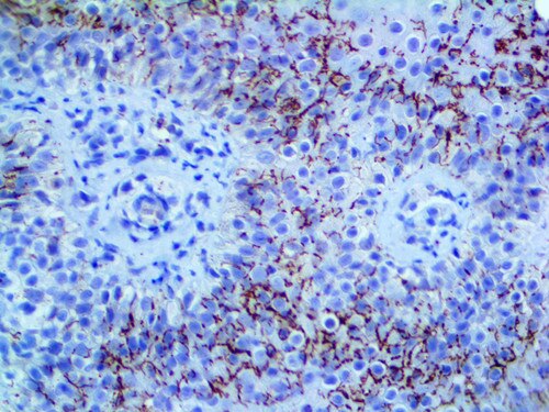 IHC of Treponema pallidum on an FFPE Infected Skin Tissue